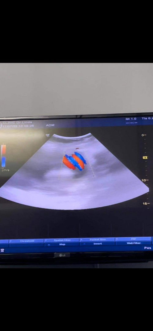 สายสะดือพันคอลูก2รอบ