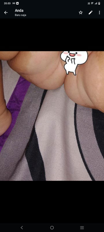 Ciri-ciri ruam popok akan sembuh