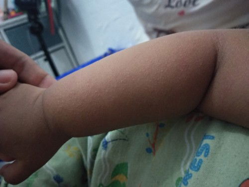 Bagaimana cara mengatasi Keringat malam/ tangan kasar