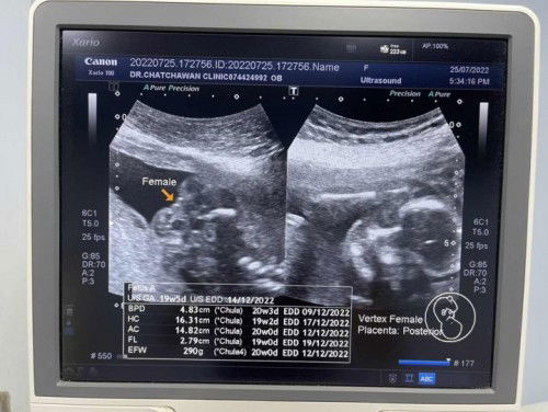 อันตร้าซาวด์เพศลูก