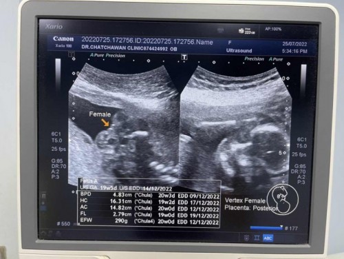 อันตร้าซาวด์เพศลูก