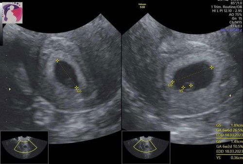 Sudah ada kantung janin dan YS , tapi belum terlihat janin 🥺