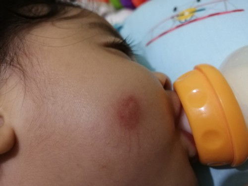 Kagat ng insekto sa balat ni baby