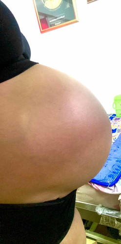 ตั้งครรภ์แฝด 33w4d แล้วจ้า นน.ขึ้นมา 11 กก. นน.ลูก 1629 กับ 1369 ไม่รู้ท้องจะแตกลายวันไหน มีแม่บ้านไหนท้องไม่แตกบ้าง
