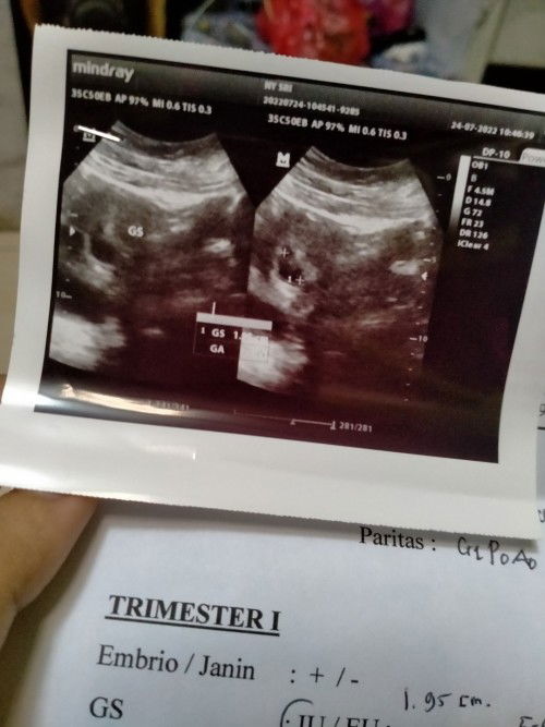 Usia kehamilan 5 minggu