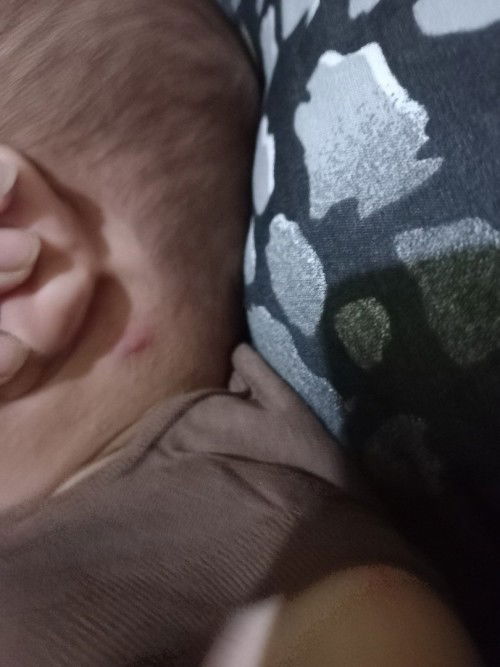 Bayi 5 bulan kena cacar air