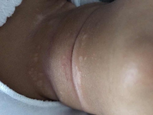 Kulit leher bayi