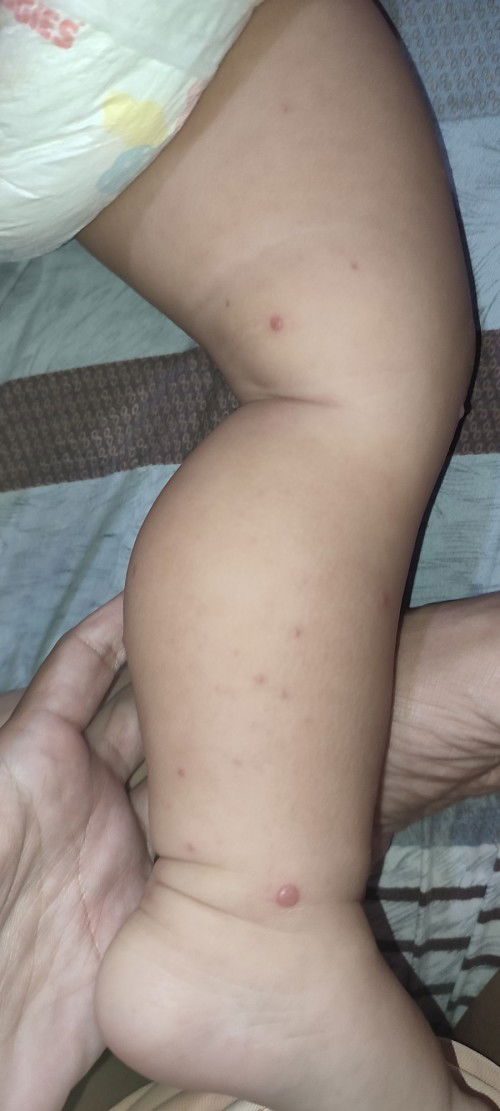 Rashes or Chicken pox?