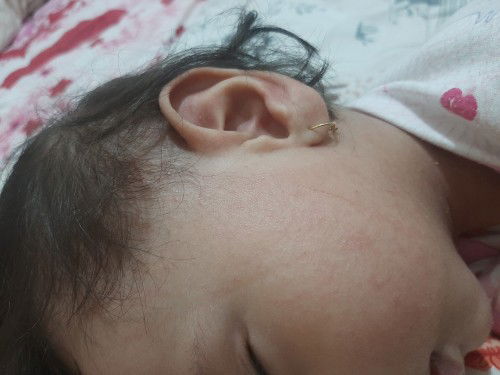 Krim yg cocok untuk bintik" di pipi baby sampai gatal" hingga ke kepala