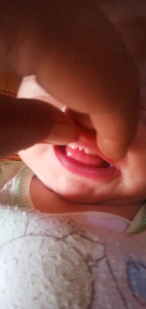 Gusi abayi baru lahir berbentuk M