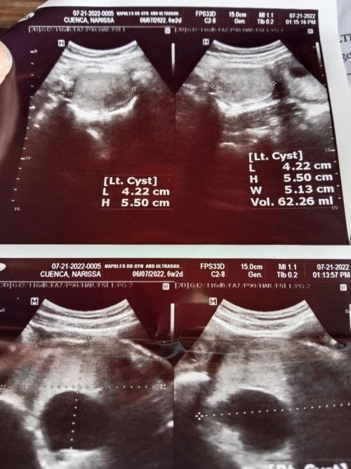 11 weeks pregnant at Meron akong bilateral dermoid cyst SA left and right sinu po same case sakin.?