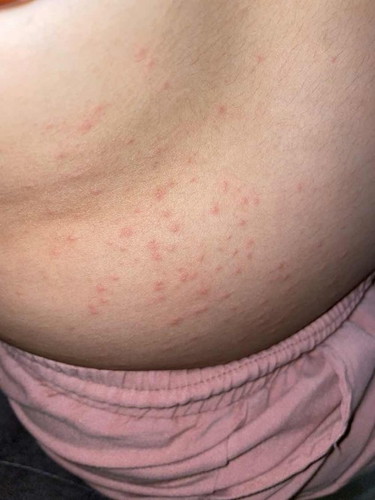 Naik gatal 7 bulan pregnant