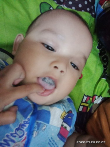 Umur anak saya 6 bulan muncul bintik hitam di mulut nya gmna cara membersihkan nya??