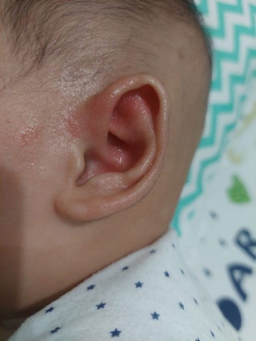 Daun telinga bruntusan dan kering seperti berketombe