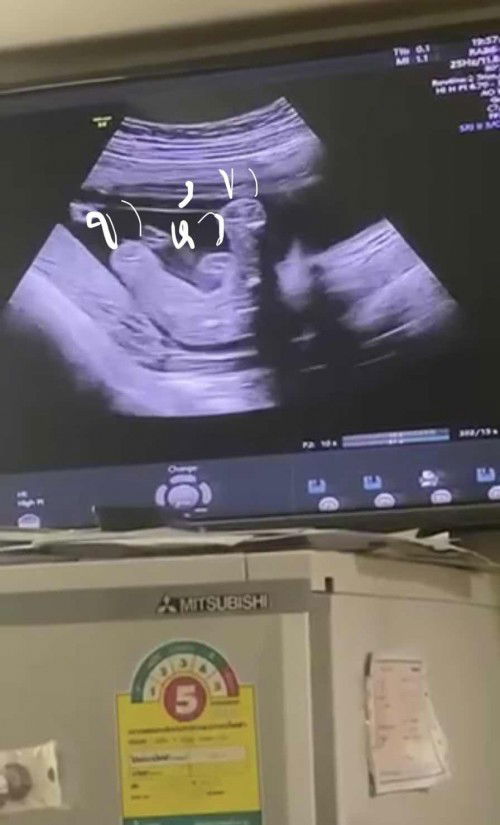 จะเอ๋ แม่ๆ จากครั้งก่อนที่เราโพสต์ถามเพศลูกจากอาการที่เราเป็นว่าจะได้ลูกชายหรือลูกสาว เราท้องได้ 19+1  ผลโหวตครั้งที่แล้ว