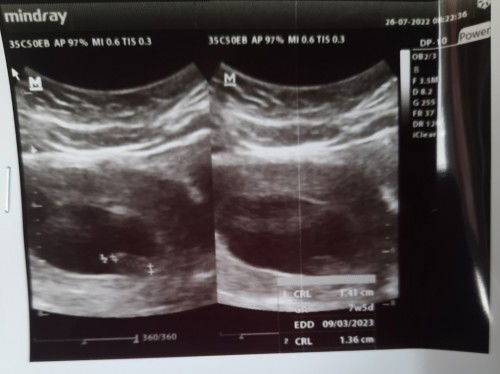 7w2d janin tidak berdetak divonia kandungan lemah.