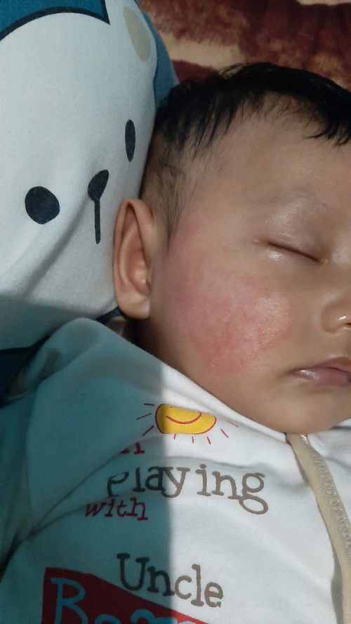 Ini kenapa ya moms?? :( ruam merah dipipi