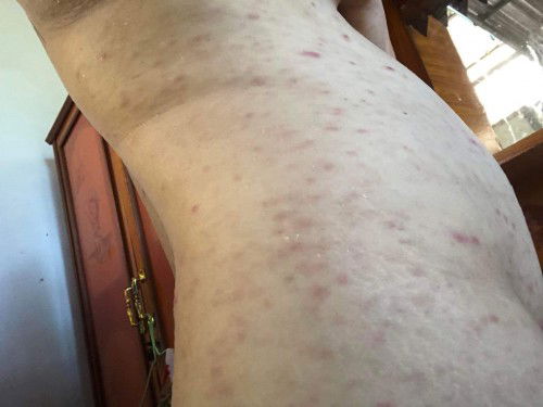 เป็นอีสุกอีใส ตอนท้อง12วีค4วัน เป็นอันตรายต่อเด็กมัยค่ะ ไปหาหมอ หมอบอกให้รอหายเอง ไม่มียากินยาทาเลย