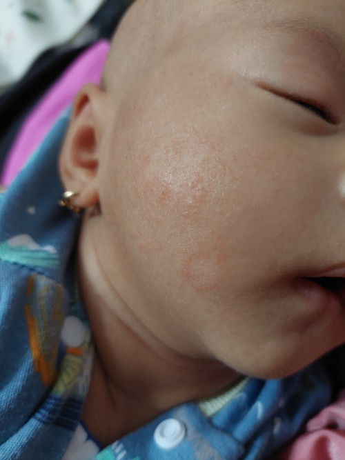 Pipi bayi merah dan kering