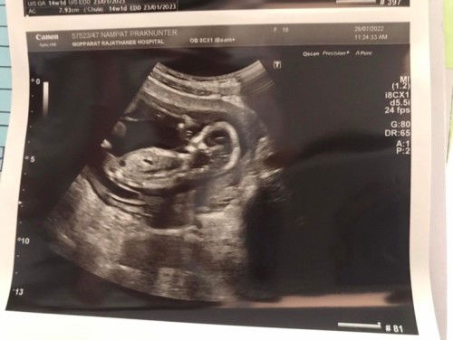 อัลตราซาวด์ครั้งแรก