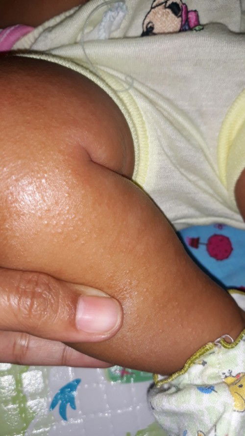 Bintik² pada kulit pada anak