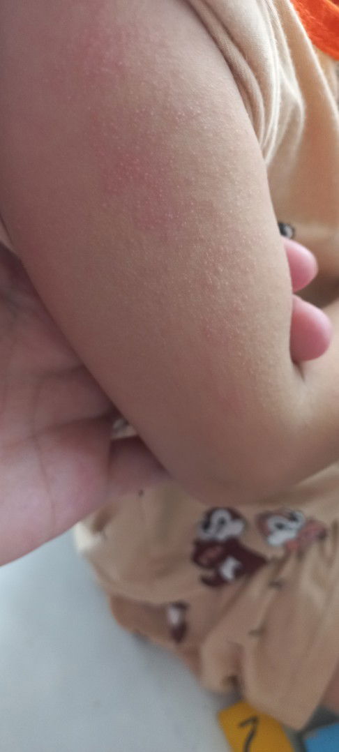 Da em bé bị nổi