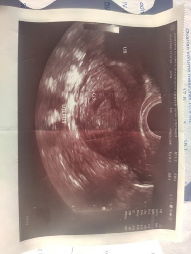 Embryonic pole and yolk sac are not visualized as per ob