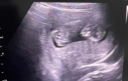 ไปซาวท้องแบบเร่งรีบตอน 12w กว่าๆ กลับบ้านมาพี่สาวทักว่าทำไมรูปซาวเหมือน 2 คน