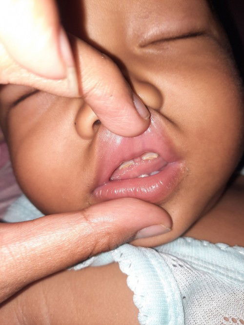 GIGI ompong pada anak