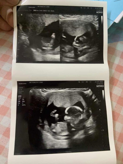 อัลตราซาวด์14วีค3วัน