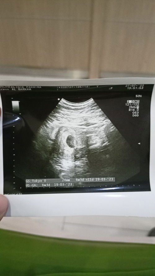 Hasil USG 6 Minggu