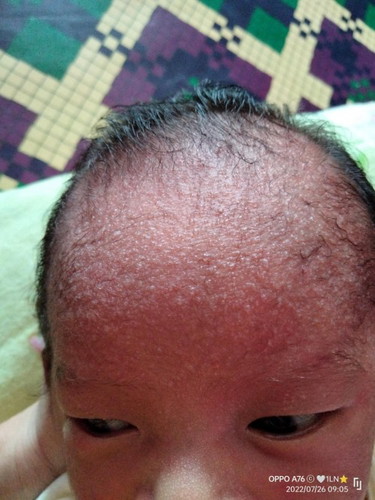 Mom, ada yg anak.y pernah seperti ini? muncul putih2 bintik berair gitu. sejak lahir 16Juli udah ada