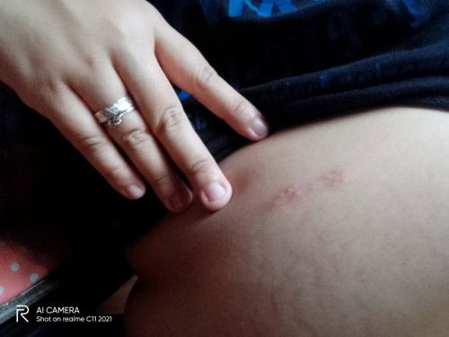 Need help po,ano po kaya ito? tumubo po sa tummy at likod ko this week lang. 12 week pregnant po ako