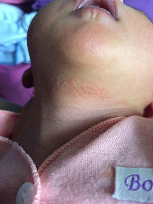 Leher bayi bintik bintik merah