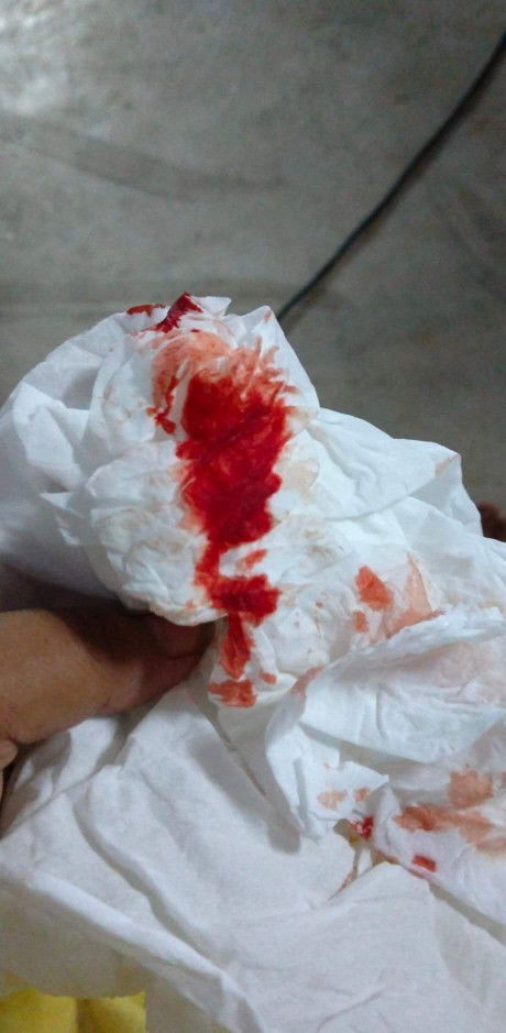 เลือดไหลตอนตั้งครรภ์ 8 เดือน