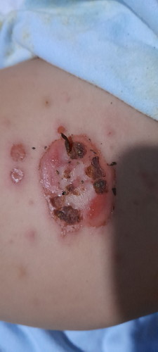 Awal.y seperti digigit nyamuk tpi semakin lebar , merah dan berair. Ada yg tau obat/salep.y bun.?