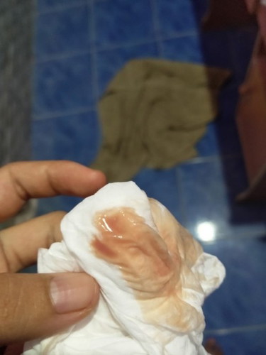 แม่ๆๆมีเลือดออกแบบนี้กันมั้ย