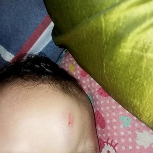 Bukol na may sugat sa noo ni baby