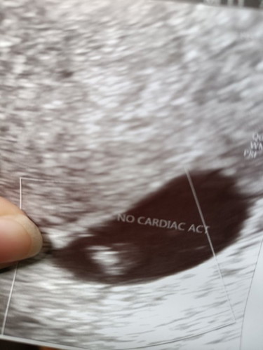 No heartbeat at 6 weeks 1 day