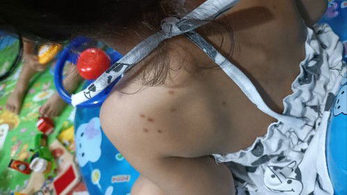 รักษารอยยุง