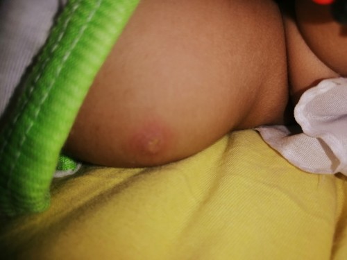 Bakuna ni baby