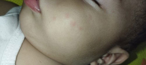 Baby rashes