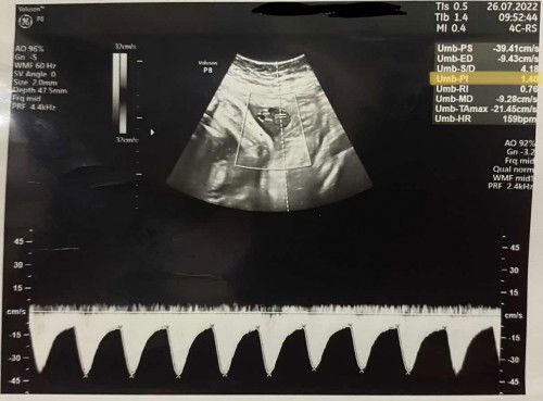 Jika hasil UMB-PI diatas 1,5 bisa terjadi Sudden Death