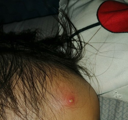 Butlig po ba to sa noo ni baby? Ano po kaya pwedeng ipahid?