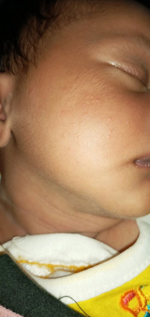 Bintik² kemerahan pada kulit wajah bayi