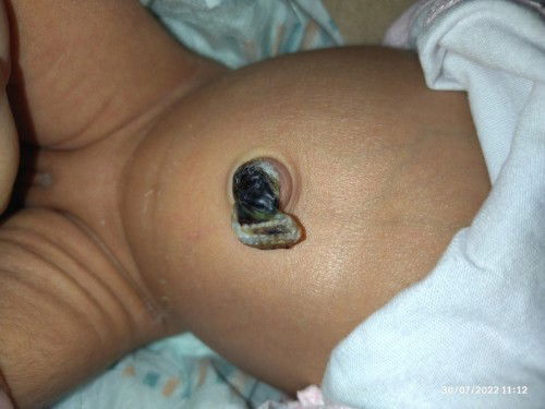 Need advice about pusod ne baby