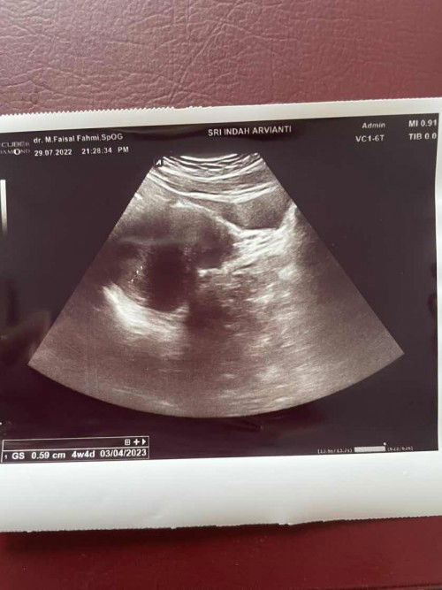 USG 4 minggu 4 hari