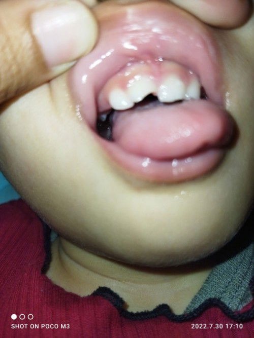 Gigi patah 😢