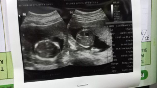 Hasil usg 17week