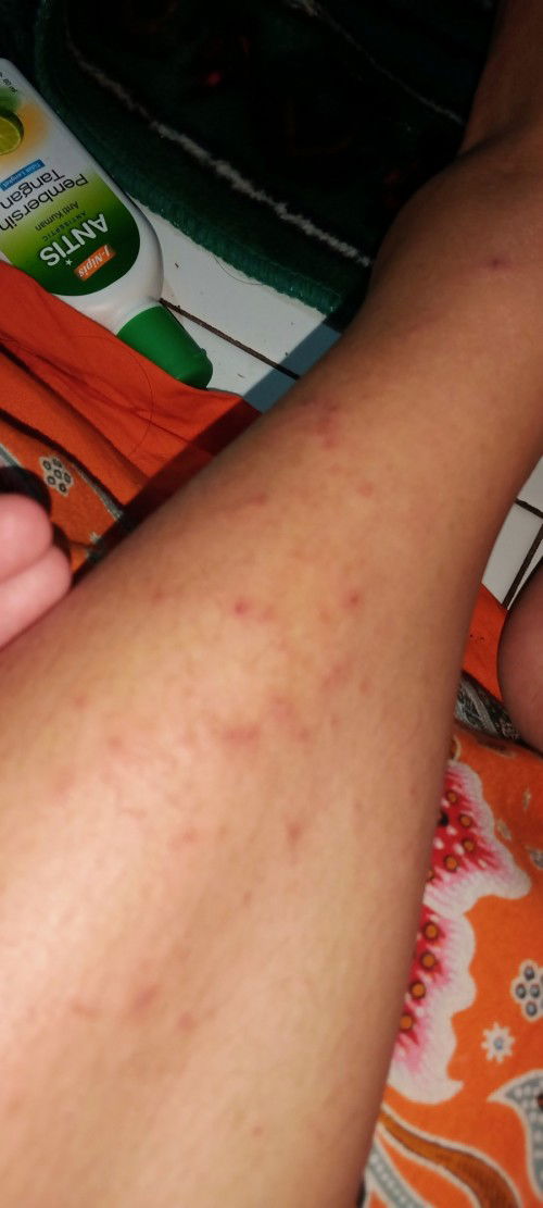 Gatal gatal diusia kehamilan 18 weeks